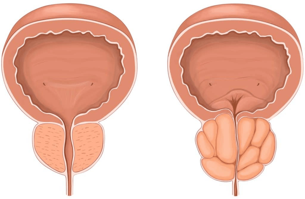 Cosa succede alla prostata durante la prostatite