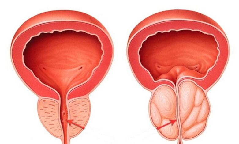Prostata sana e infiammata con prostatite