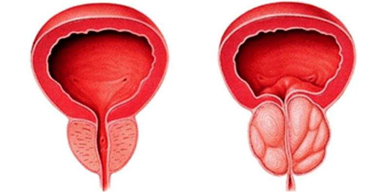 Ghiandola prostatica normale e infiammata